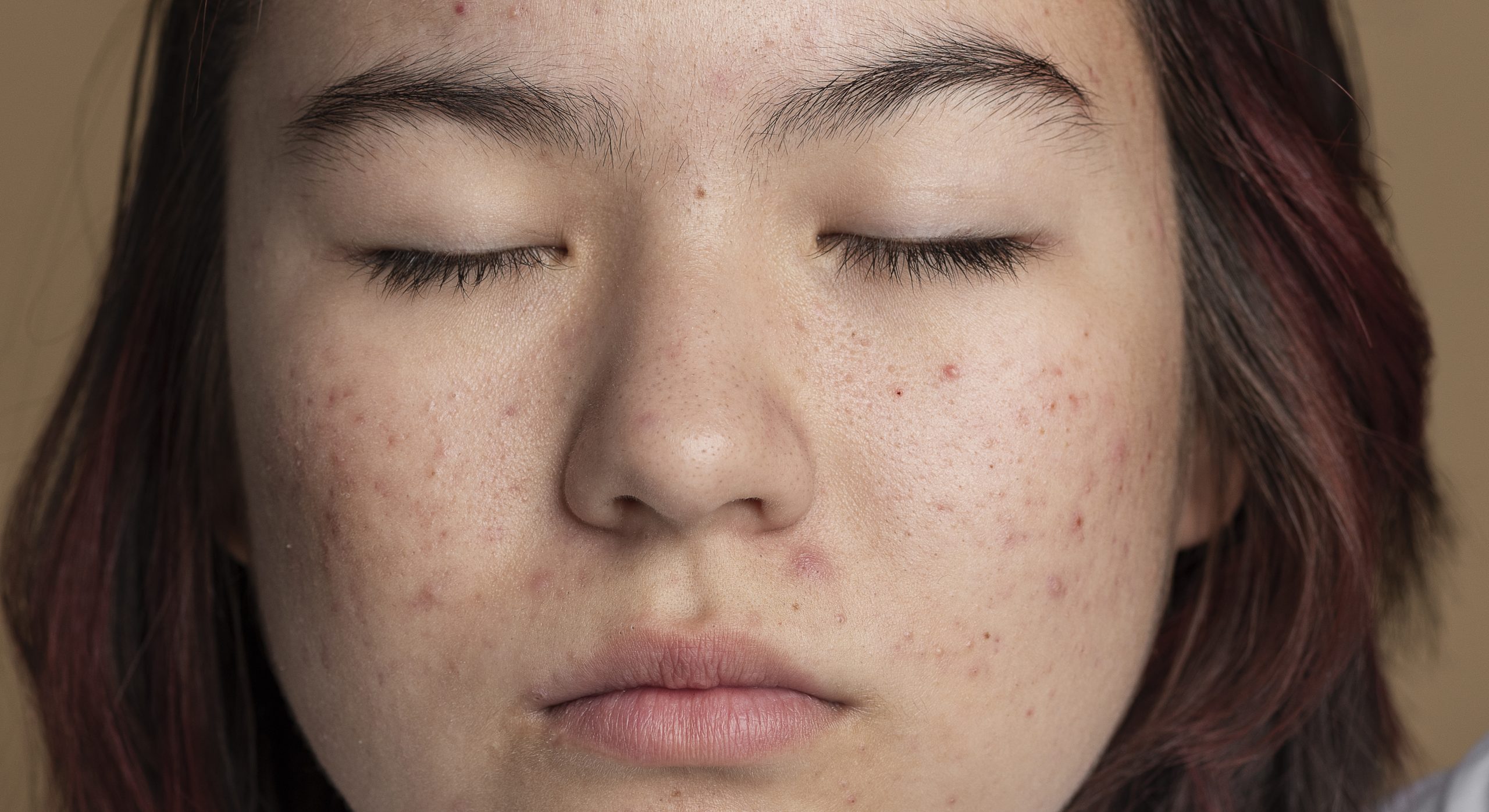 Kandungan Skincare yang Efektif untuk Mengatasi Jerawat pada Wajah